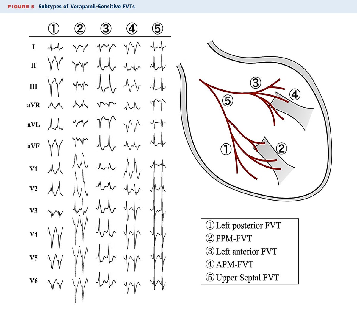 📚Two great reviews #EPeeps should read simultaneously!

🫀Purkinje-related VT/VF classification/mechanisms/therapy
🫀New schema involving septal fascicle for fascicular VT

🔗:tinyurl.com/4vwhdv6h
🔗:tinyurl.com/3f4kt6a5
👏<a href="/WongChrisX/">Chris Wong</a> <a href="/AkihikoNogami/">Akihiko Nogami</a> <a href="/HHsiaMD/">Henry Hsia</a> <a href="/JACCJournals/">JACC Journals</a>