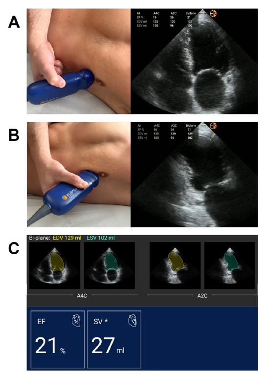 How can we improve #POCUS utility and democratize application - #AI augmentation! Both senior and novice scanners can rapidly and accurately measure and classify LVEF across clinical settings (echo lab, ward, ED, ICU).