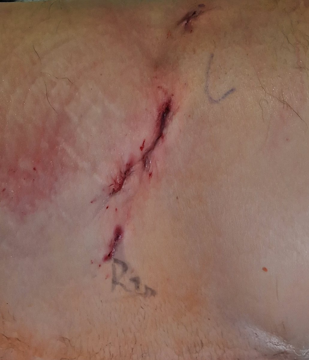 Denosshan Sri (@denosshansri) on Twitter photo A day of retroperitoneal upper tract surgery <a href="/GeorgesUrology/">St George's Urology</a> for our <a href="/RCSnews/">The Royal College of Surgeons of England</a> 🤖 fellow <a href="/EucedaCerna/">Luis Euceda Cerna</a>, including his first solo retroperitoneal case (benign nephrectomy) 🫡 🦾. Hiding the stress well underneath his 😊. #plataoplomo A day of retroperitoneal upper tract surgery <a href="/GeorgesUrology/">St George's Urology</a> for our <a href="/RCSnews/">The Royal College of Surgeons of England</a> 🤖 fellow <a href="/EucedaCerna/">Luis Euceda Cerna</a>, including his first solo retroperitoneal case (benign nephrectomy) 🫡 🦾. Hiding the stress well underneath his 😊. #plataoplomo