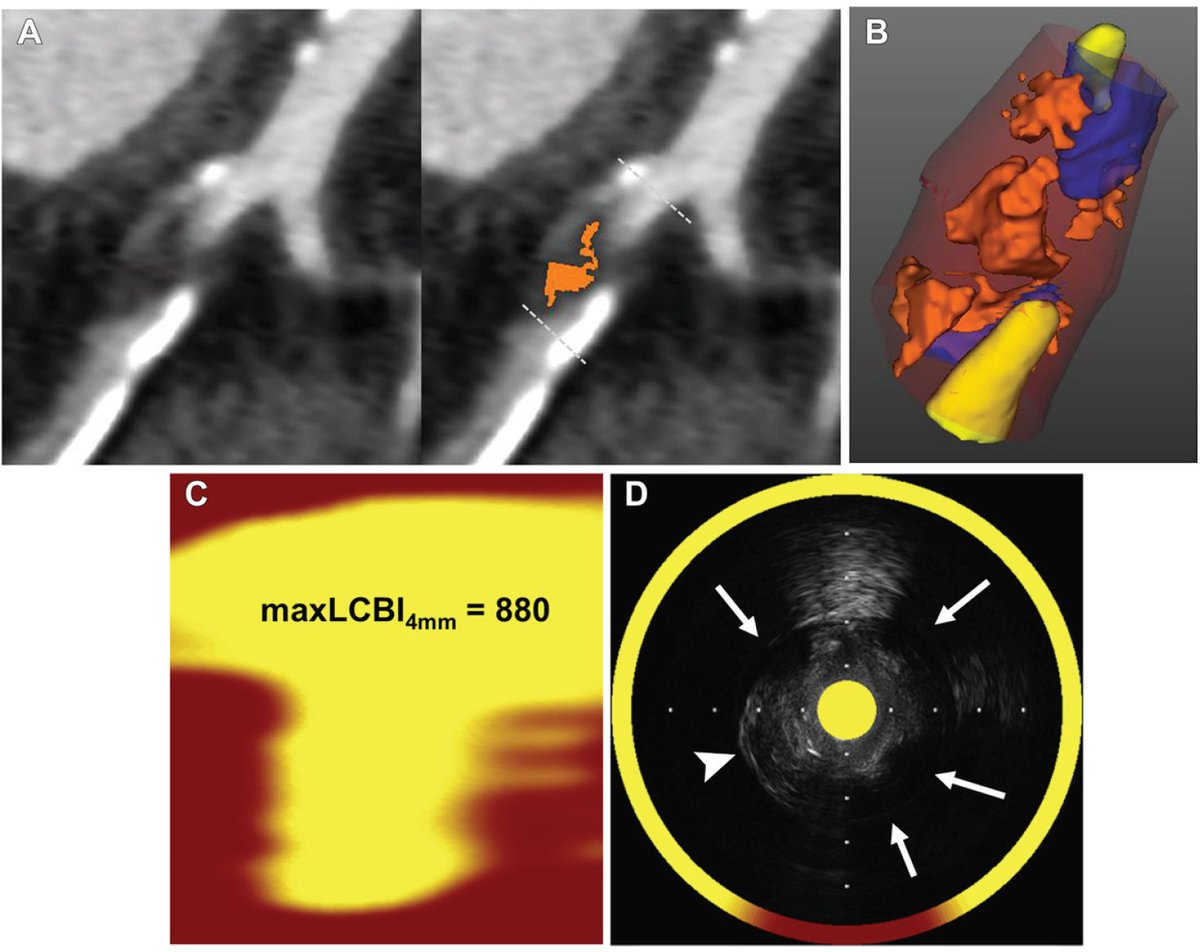 Damini Dey (@damini_dey) on Twitter photo Low-Attenuation Plaque Burden from Coronary CT Angiography related to NIRS-IVUS in a Head-to-Head Comparison. Our dual-center study. pubs.rsna.org/doi/10.1148/ry… <a href="/RadiologyCTI/">Radiology: Cardiothoracic Imaging</a> <a href="/csmcbiri/">Cedars-Sinai Biomedical Imaging Research Institute</a> <a href="/Heart_SCCT/">Heart_SCCT</a> Low-Attenuation Plaque Burden from Coronary CT Angiography related to NIRS-IVUS in a Head-to-Head Comparison. Our dual-center study. pubs.rsna.org/doi/10.1148/ry… <a href="/RadiologyCTI/">Radiology: Cardiothoracic Imaging</a> <a href="/csmcbiri/">Cedars-Sinai Biomedical Imaging Research Institute</a> <a href="/Heart_SCCT/">Heart_SCCT</a>