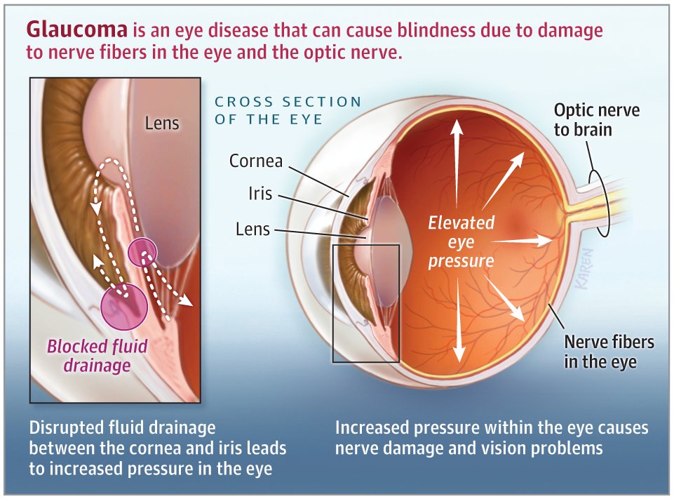 What Causes Blindness?