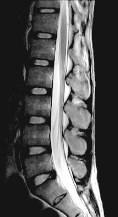 A 75 Year Old Woman Comes To The ED With 3 Days Of Low Back Pain a-75-year-old-woman-comes-to-the-ed-with-3-days-of-low-back-pain
