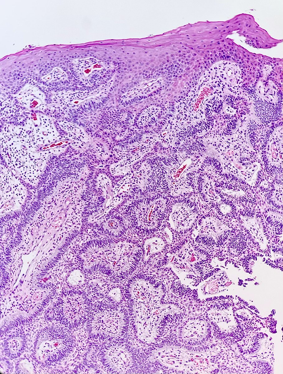 87-year-old male with a recurrent tumor in soft tissues of posterior alveolar ridge. What is your diagnosis? #ENTpath #OralPath #SurgicalPath -#pathology