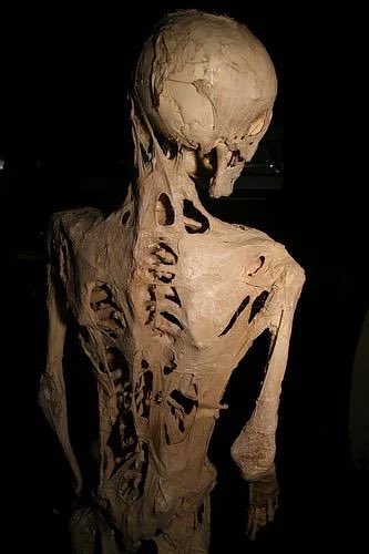 MorbidKnowledge's tweet photo. The skeleton of Harry Eastlack, a man that suffered from fibrodysplasia ossificans progressiva, a genetic disorder that resulted in any injury being "repaired" by turning into bone. https://t.co/em51YOwykE