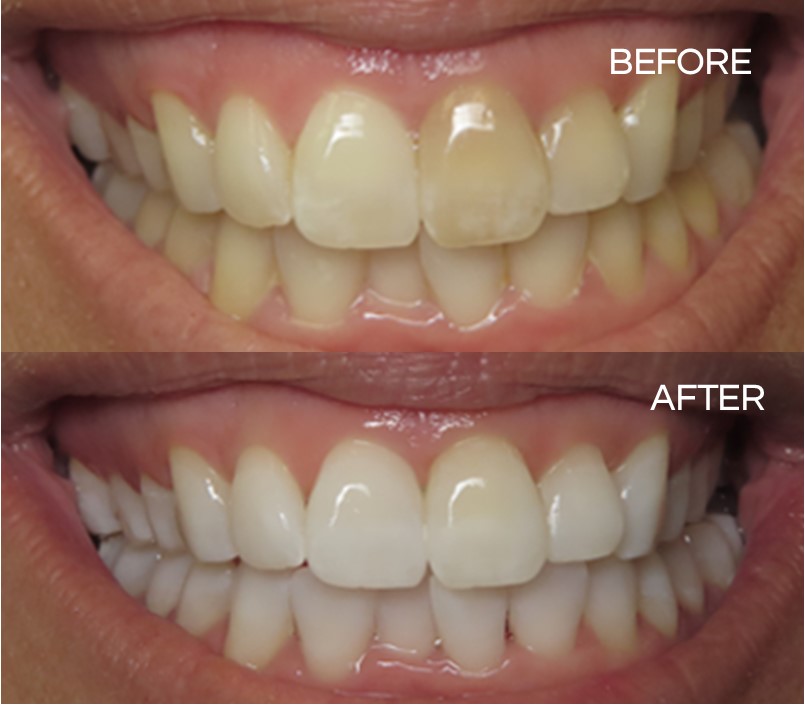 thetooth_dr's tweet photo. The before photo is of a patient with stained teeth. The after photo was achieved with a dental whitening procedure.
#flossdental #thetoothdr #flossboss #beforeandafter #stainedteeth #dentalwhitening #boulevard #dentist #oralhygiene #dentistry #trinidadandtobago https://t.co/TMWWpCXmTy