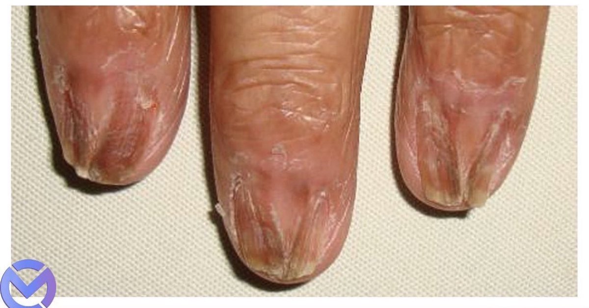 An Atlas of Nail Disorders, Part 12 | Consultant360