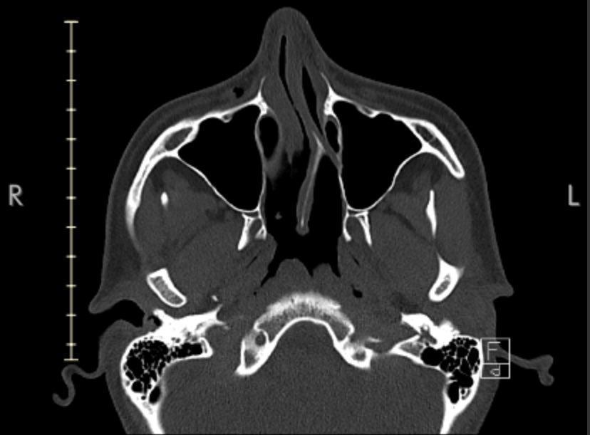 punchSkunk's tweet image. hey y’all sorry for the absence but i was hat3cr!med about two weeks ago. my ptsd has worsened and i need surgery to repair my internal septum so that i can breathe. because of this i’m looking to take coms, ychs, and get rid of some adopts. more info in the following thread 🧵