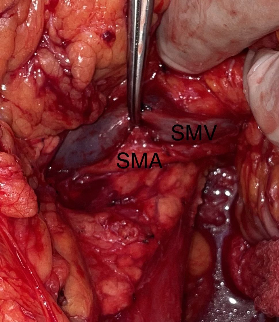 Csaba Gajdos MD, FACS, FSSO (@csabagajdos1) on Twitter photo Skeletonized superior mesenteric artery SMA and vein SMV during Whipple
<a href="/UBSurgery/">Department of Surgery | University at Buffalo</a> <a href="/Jacobs_Med_UB/">Jacobs School at University at Buffalo</a> <a href="/KaleidaHealth/">Kaleida Health</a> <a href="/ASOChat/">ASO Chat</a> Skeletonized superior mesenteric artery SMA and vein SMV during Whipple
<a href="/UBSurgery/">Department of Surgery | University at Buffalo</a> <a href="/Jacobs_Med_UB/">Jacobs School at University at Buffalo</a> <a href="/KaleidaHealth/">Kaleida Health</a> <a href="/ASOChat/">ASO Chat</a>