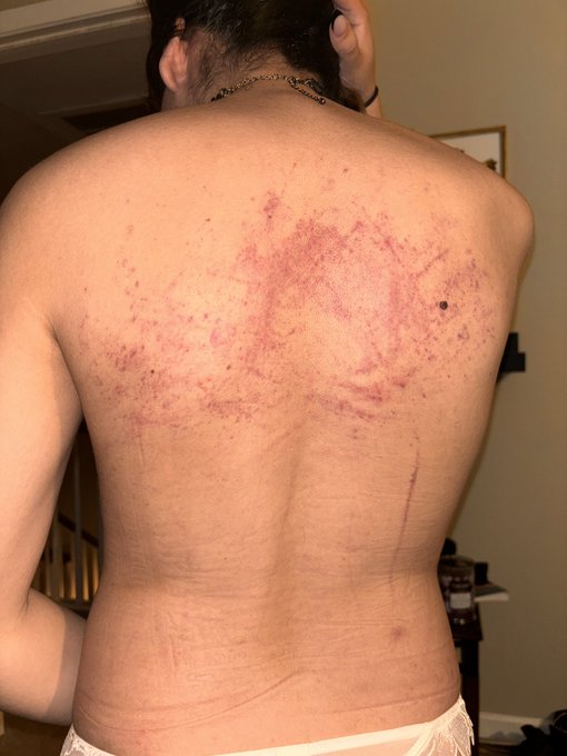 The aftermath of tonight&rsquo;s party I&rsquo;m so happy to have marks from @EmpressMysti ☺️☺️ https://t.co/ePL<a href="/tag/mvsales"class="tags"><span>#mvsales</span></a>