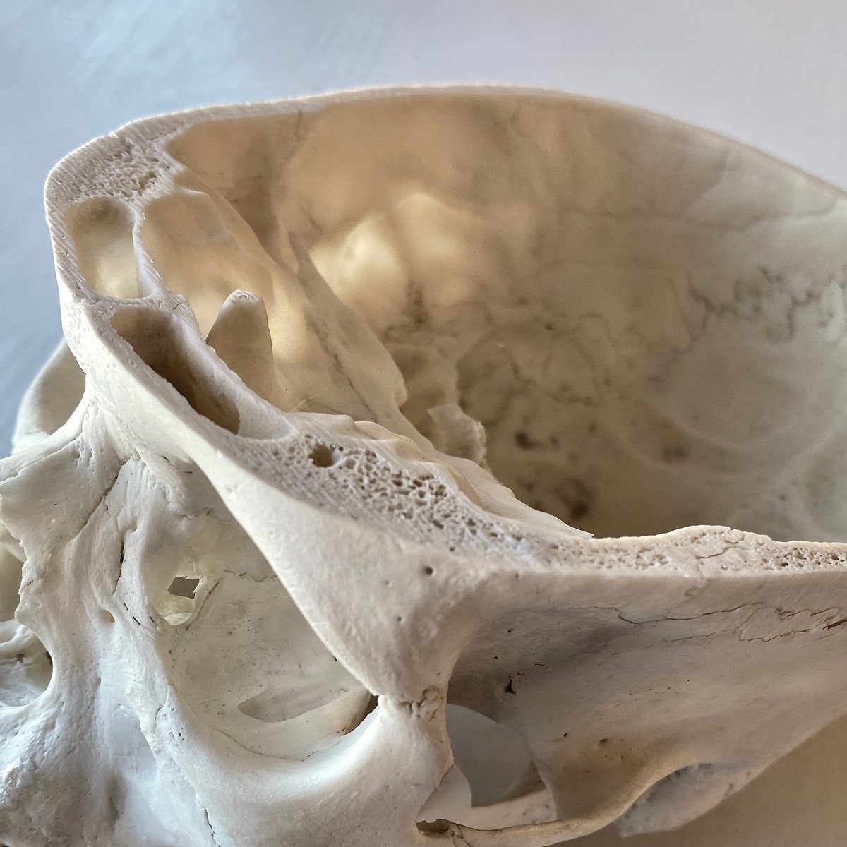 GeorgeARauscher's tweet photo. The Human Frontal Sinus: We Need It!
#forensic #forensicanthropology #frontalsinus #anatomy #physiology #clinicalresearch #surgicalinterventions #diagnostics #forensicidentification #forensicscience #skullanatomy #medicalresearch #vocalresonance #airconditioning #histology #cranialbones #forensicmedicine #respiratorysystem #forensicstudies #paranasalsinuses
The frontal sinus is an intriguing anatomical structure with a complex physiological role that extends far beyond its simple existence as an air-filled cavity. Nestled within the frontal bone of the human skull, this sinus is part of the larger paranasal sinus system that also includes the maxillary, ethmoid, and sphenoid sinuses. Its functions range from air filtration and humidification to contributing to vocal resonance and even playing a role in individual identification in forensic contexts. This paper provides an in-depth exploration of the multifaceted importance of the frontal sinus.
The frontal sinus is embedded within the frontal bone, one of the eight cranial bones that make up the human skull. The frontal bone itself is a flat bone consisting of three layers: the outer table, the diploë, and the inner table. The frontal sinus is located between the outer and inner tables of the frontal bone and varies significantly in size, shape, and extent of pneumatization among individuals.
Histologically, the frontal sinus is lined with a mucous membrane consisting of pseudostratified ciliated columnar epithelium. This lining is interspersed with goblet cells that produce mucus and ciliated cells that propel the mucus towards the nasopharynx. This forms part of the body's natural defense mechanism, trapping and removing foreign particles and microorganisms from the airways.
One of the primary roles of the frontal sinus is to condition the air we breathe. As air passes through the sinus, it is warmed and humidified, optimizing it for gas exchange when it reaches the alveoli in the lungs. This function is crucial for maintaining effective and efficient respiration.
The frontal sinus also contributes to the quality and timbre of the human voice. The air-filled cavity acts as a resonating chamber, affecting the quality of sound produced during phonation. This is particularly important in the context of vocal identity and may even have implications in social and psychological aspects of human interaction.
In a clinical setting, the frontal sinus often becomes a point of focus in the diagnosis and management of various conditions. Acute or chronic frontal sinusitis can manifest as severe headaches, facial pain, and even lead to complications like orbital cellulitis. Advanced imaging techniques, such as CT scans, are invaluable tools for detailed anatomical study and for identifying pathological changes.
Surgical approaches like Functional Endoscopic Sinus Surgery (FESS) are employed for treating chronic sinusitis and anatomical anomalies that impair sinus drainage. Detailed preoperative planning is imperative, and this requires an intimate understanding of the complicated anatomy of the frontal sinus.
In forensic anthropology, the unique anatomical variations in the size and shape of the frontal sinus can serve as an identifier, almost akin to a fingerprint. It has been utilized in various scenarios for identification, from criminal investigations to archaeological studies.
The frontal sinus is not merely an anatomical oddity; it is a critical structure with far-reaching physiological, clinical, and forensic implications. Its study is not only essential for understanding human anatomy but also for various applied sciences.