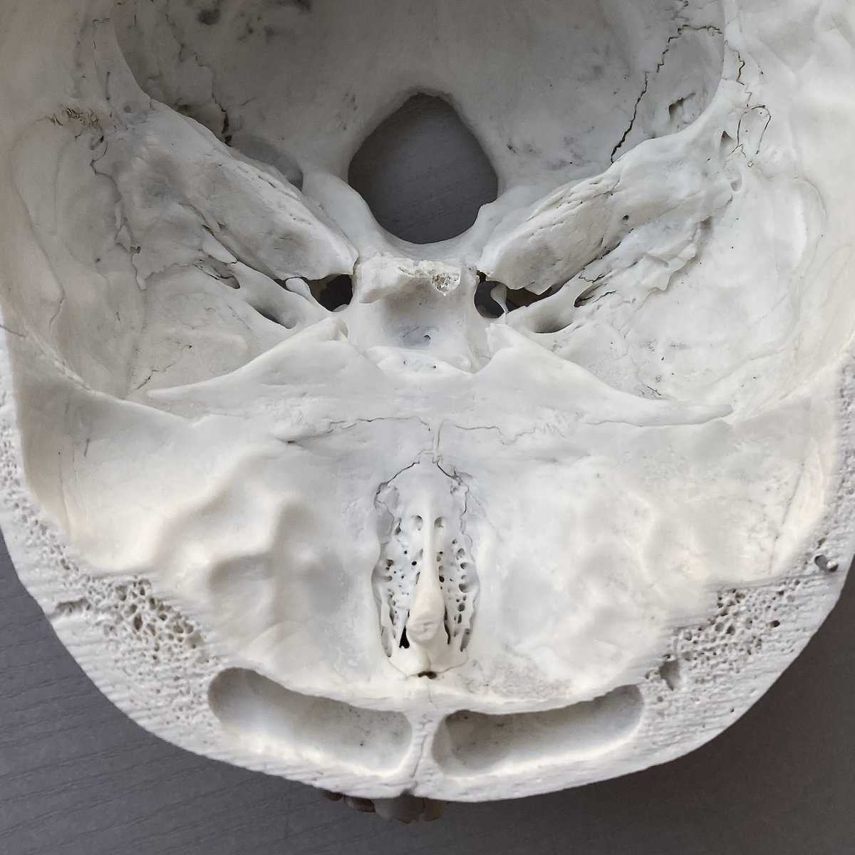 The Human Frontal Sinus: We Need It!
 
#forensic #forensicanthropology #frontalsinus #anatomy #physiology #clinicalresearch #surgicalinterventions #diagnostics #forensicidentification #forensicscience #skullanatomy #medicalresearch #vocalresonance #airconditioning #histology