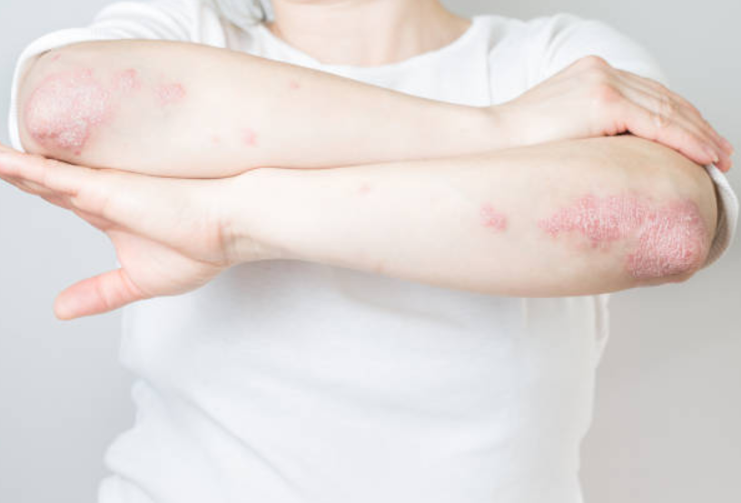 accionpsoriasis's tweet photo. Hoy es el #DíaMundialPsoriasis2023 👉 La #psoriasis es una enfermedad inflamatoria crónica que se presenta en brotes y afecta la piel, las uñas y las articulaciones. 

La psoriasis NO es contagiosa... Pero la información, SÍ. ¡Comparte! https://t.co/u6eCjW58Yk #WorldPsoriasisDay https://t.co/Dt6iM0I98s