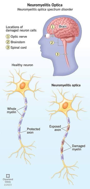 modernHealthMe's tweet photo. #Devic's disease - Neuromyelitis optica
➡️#Autoimmune disorder.
➡️Aquaporin-4 antibodies.
➡️Optic #Neuritis(Vision Loss)
➡️Myelitis
➡️Pain
➡️Loss of Coordination
➡️Muscle Weakness
Rx
➡️corticosteroids,Rituximab
➡️Plasma Exchange (#Plasmapheresis) #MedTwitter @IhabFathiSulima https://t.co/YnRTxXC2Vm