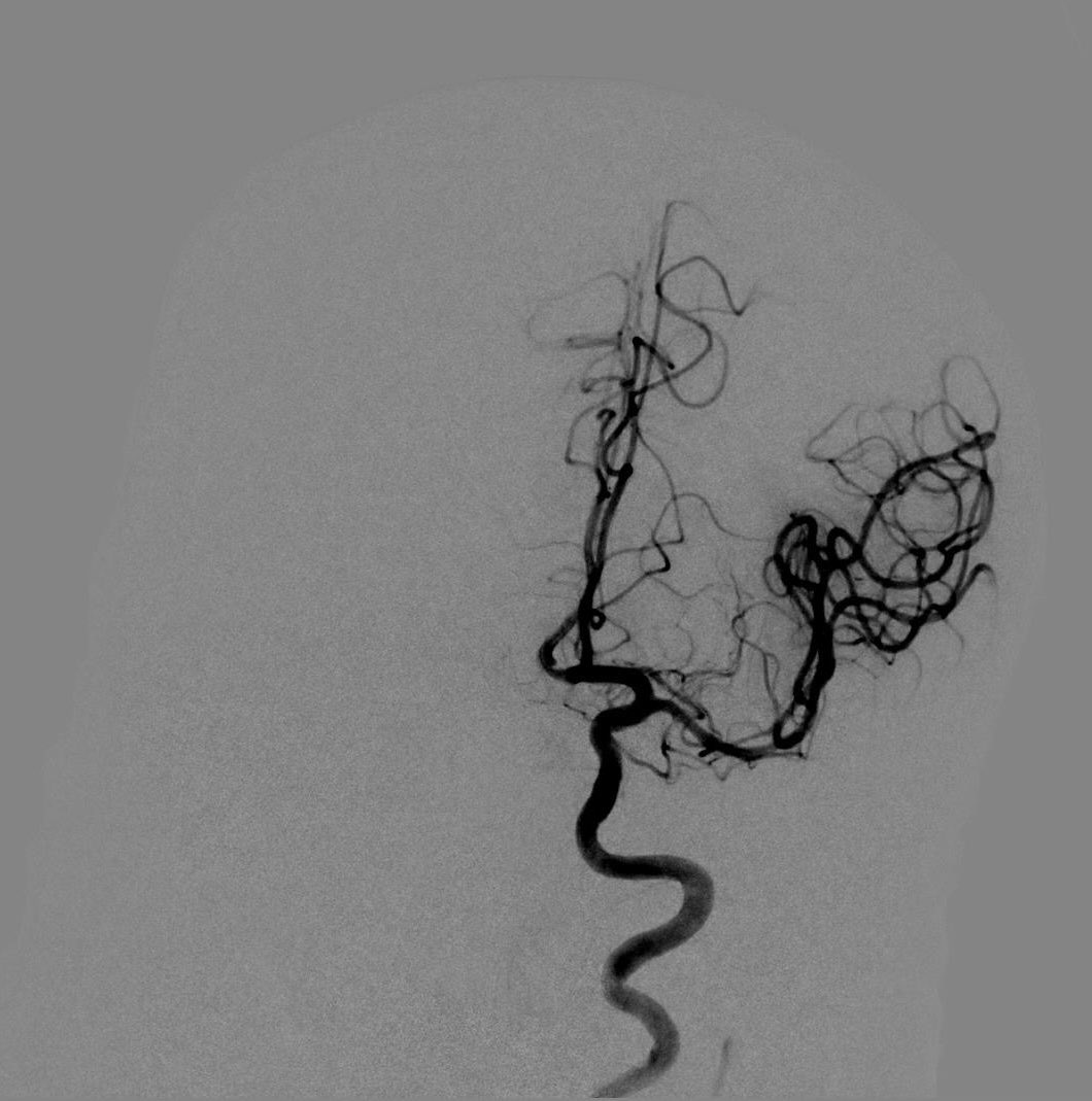 VirTauli's tweet photo. Hoy #casereport en el #díamundialdelictus 🧠👇🏽

Ictus ACM1 izq. TEV con trombectomía mecánica.
⏰ de punción femoral 6.42h con TICI inicial 0.
⏰ revascularización 7.03 con TICI final 3 y perfusión completa. 

#timeisbrain 

@parctauli @Fundacioictus @Ricors_Ictus @sedenered https://t.co/Hq42i9YWVP
