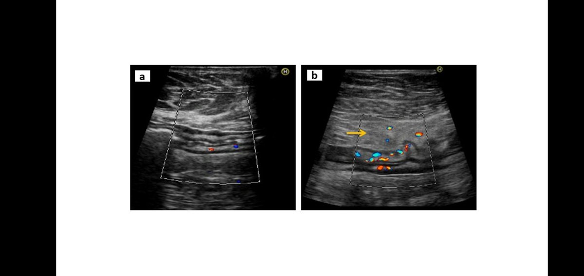 Wonderful initiative by CCF (India).... Nurturing postgraduates in IBD. Discussing ASUC and Intestinal Ultrasound with a distinguished panel and enthusiastic students.
<a href="/CCF_IN/">CCF(India)</a> <a href="/BowelUltrasound/">InternationalBowelUS</a>
<a href="/Nareshbhat14/">Naresh bhat</a>