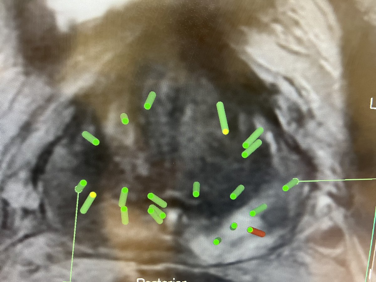 Highlighting the position of prostate biopsies using the CamProbe device in tandem with MR/USS fusion technology. Exploring advancements for better patient outcomes. #ProstateBiopsy #CamProbe #MRUSSFusion #Koelis <a href="/VincentGnanapr3/">Vincent J Gnanapragasam</a>