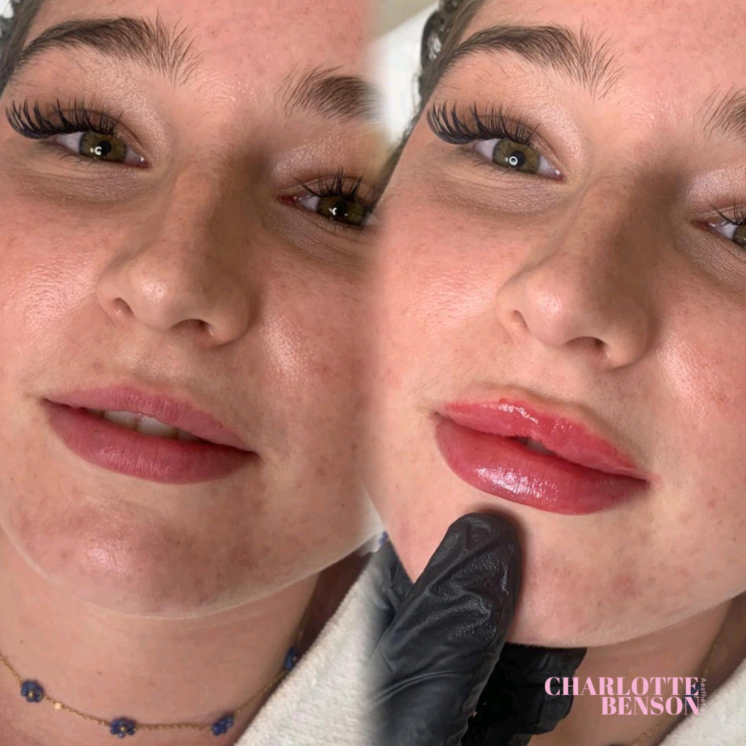 cb_aesthetics_'s tweet photo. The CB Lip Technique is a technique that allows us to totally reconstruct the vertical anatomy of the lip.
The technique lifts and accentuates the cupids bow giving a doll - like, natural look.

You will also notice a flatter appearance, as height is the goal, rather than volume. https://t.co/UjOFb1V6Yd