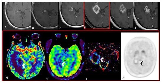 Radiosurgery for Brain Metastases: Challenges in Imaging Interpretation after Treatment. 🇮🇹
#srs #radiology #radonc 
mdpi.com/2072-6694/15/2…