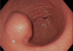 aegastro's tweet photo. No es infrecuente encontrarse de manera incidental lesiones subepiteliales mientras realizamos alguna gastroscopia o colonoscopia:
🤔¿qué son?
¿Qué exploraciones complementarias se necesitan?
¿Cuál es el seguimiento?
▶️Dentro #hiloAEG #grupojovenAEG sobre lesiones submucosas https://t.co/uaexC2dcyO