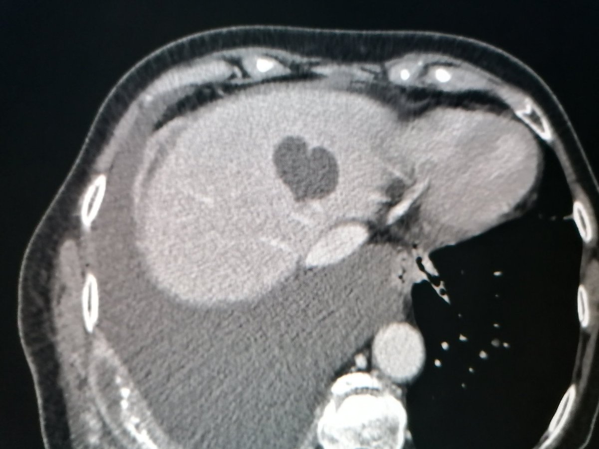MarcoGuglielmo's tweet image. When the heart is always present, even in your collateral findings ♥️

@AnnaGiuliaPavon @gpontone1 @PezelT @RNijveldt @alessia_gimelli  @EACVIPresident @FiRSTSCCT
#multimodality #YesCCT