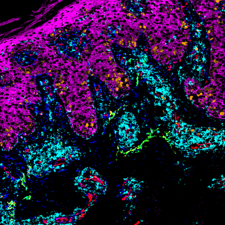 mdvesely's tweet photo. Today is #WorldPsoriasisDay. Additional research is needed to advance therapies for people living with #Psoriasis and #PsoriaticArthritis #PsoriaticDisease.

Here is a multiplex image of #psoriasis using #MIBI @IonpathOfficial. Please support @NPF @IpcPs @PsoriasisIFPA https://t.co/MCzevW9cKK