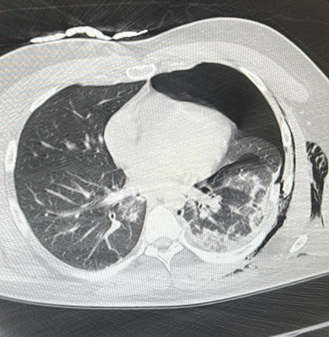 Conservative management of traumatic pneumothorax. Challenging dogma. 150 patients randomised to the @CoMiTEDTrial as of Sunday evening! The largest RCT in traumatic pneumothorax ever. With 70% out of hours recruitment the clinical buy in is amazing. Thanks to all teams involved