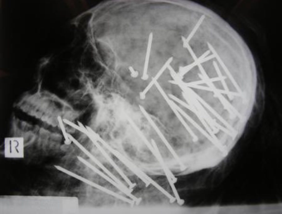 This harrowing x-ray shows how 27-year-old Chen Liu died. He was found in the marshlands outside Sydney, Australia, after being shot with a nail gun 34 times.