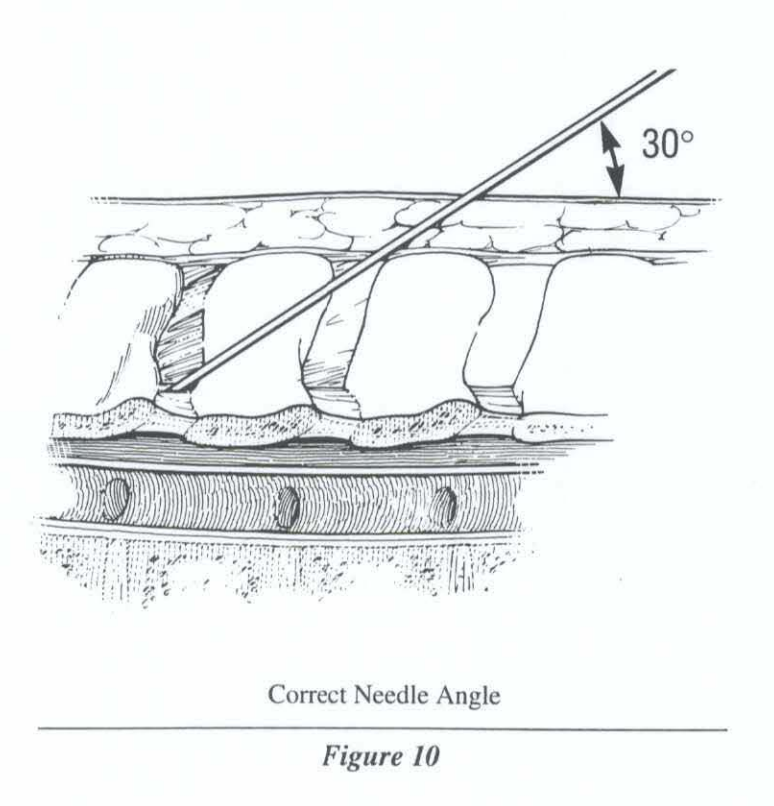 MaromBikson's tweet photo. History &amp; practice of SCS: "Implantation Guidelines for Percutaneous Spinal Cord Stimulator" Neuromed Inc 1993.  https://t.co/A3ZTkACJo2
(Over years Neuromed became Advanced Neuromodulation Systems, then St Jude Medical, then @AbbottNews neuromodulation) https://t.co/soC7f0Civx