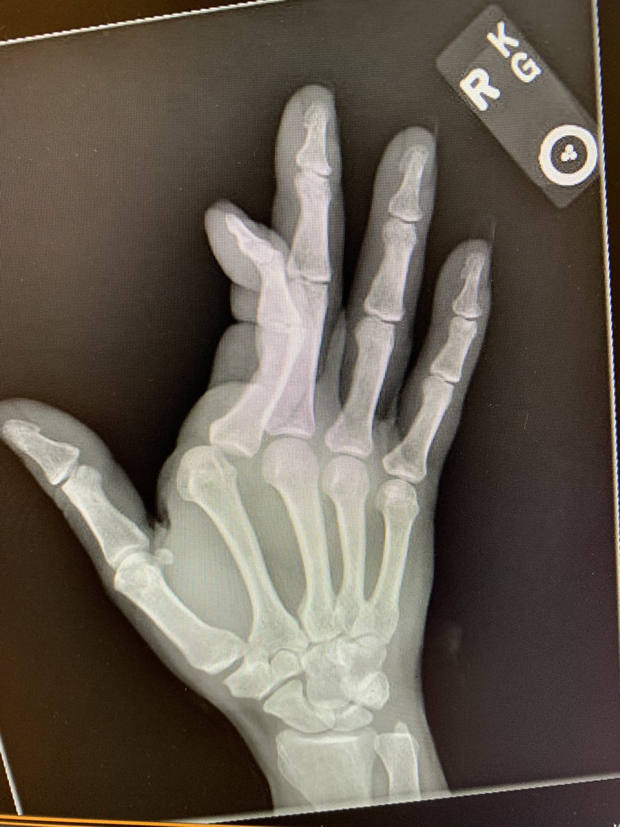 This dislocation presented to the ED and despite successful digital block was not able to be reduced on multiple attempts by multiple different physicians…why?