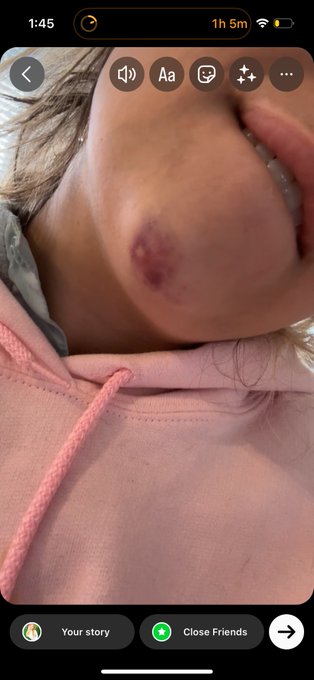 MUTUAL AID REQUEST:  earlier this month, i got jumped by 5+ men &amp; kicked in the jaw --  landed in the
