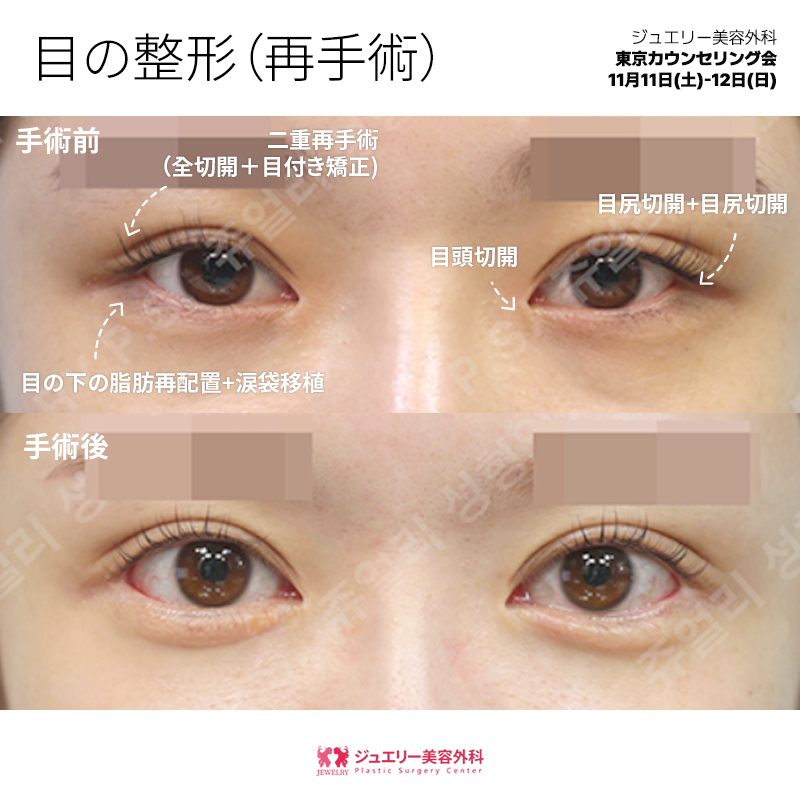 jewelrypsjapan's tweet image. 𝕁𝕖𝕨𝕖𝕝𝕣𝕪 𝕡𝕤 𝕛𝕒𝕡𝕒𝕟 ✩ﾟ

✴ #目の整形 再手術

・二重再手術 (全切開)
・目つき矯正
・目尻切開＋タレ目形成
#目の下の脂肪再配置
 ・ 涙袋脂肪移植

💎 11月東京カウンセリング会開催
💎 申請先 : zrr.kr/jWTB
💎 LINE : lin.ee/fbluEfo