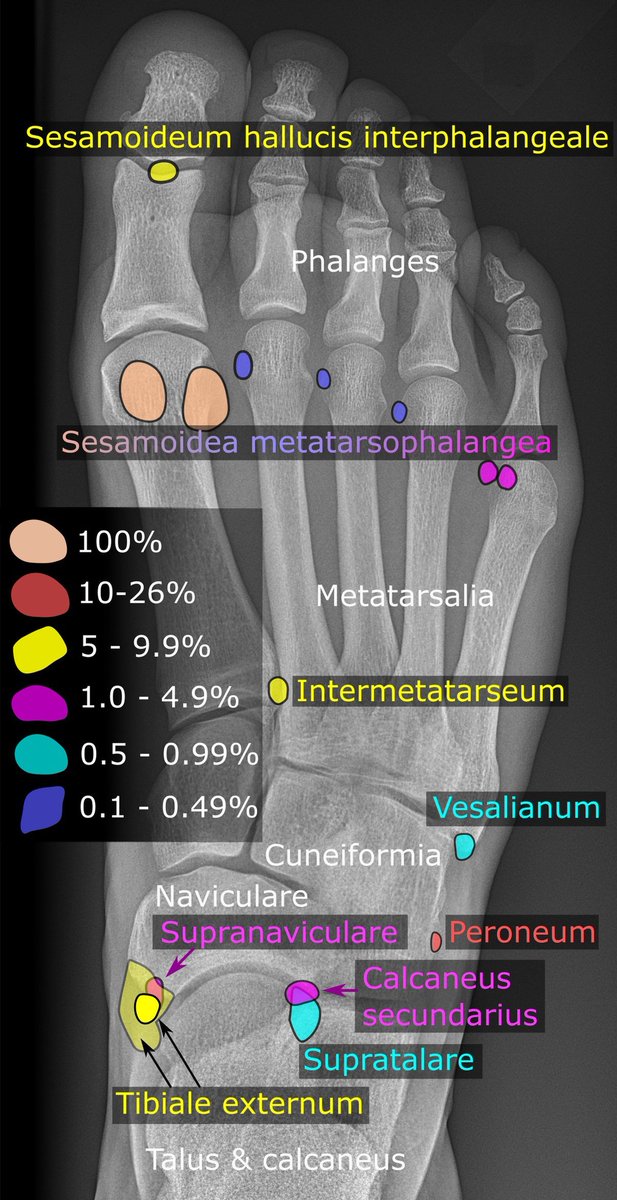 samrad77's tweet photo. Numerous ossicles in the ankle or foot can be mistaken for fractures. When in doubt, ask yourself, "Is this a common ossicle versus a rare fracture, or a common fracture versus a rare ossicle?" This approach usually works.

Wikipedia images show normal ossicles of the foot! https://t.co/9r6o4BGtu7