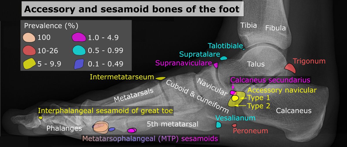 samrad77's tweet photo. Numerous ossicles in the ankle or foot can be mistaken for fractures. When in doubt, ask yourself, "Is this a common ossicle versus a rare fracture, or a common fracture versus a rare ossicle?" This approach usually works.

Wikipedia images show normal ossicles of the foot! https://t.co/9r6o4BGtu7