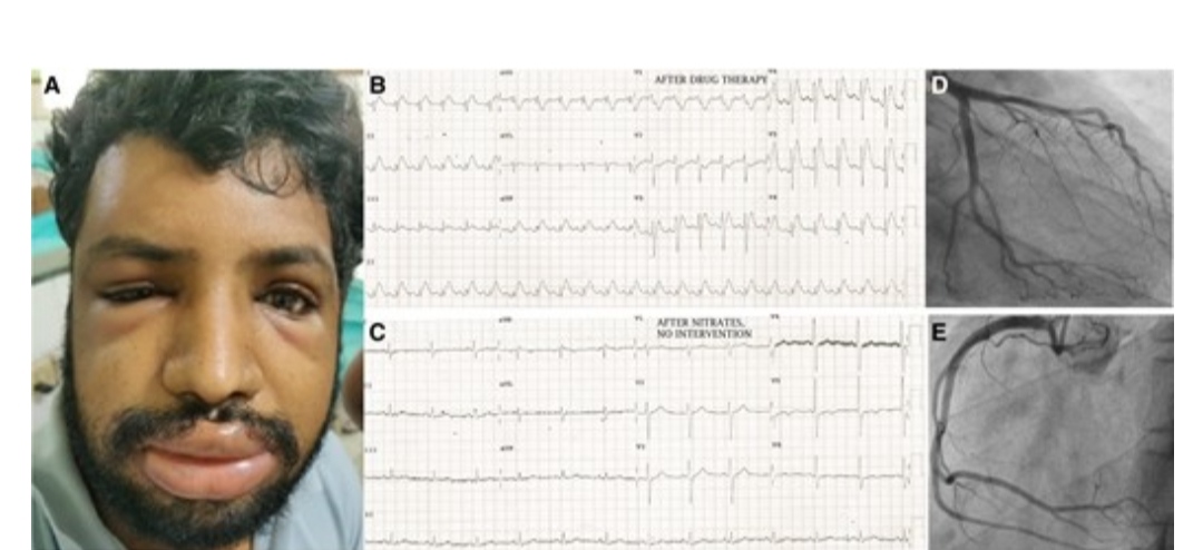 Monday challenge - New #SpotTheDiagnosis is out! #EHJACVC bit.ly/45RH3Vf

What's the next step?

1. 🚫 capecitabine+add NTG+ MP+ ranitidine
2. continue capecitabine+ add ASA+BB+Mo
3. 🚫 capecitabine+add clopidogrel+uridine acetate
4. 🚫 capecitabine+ colchicine+ibuprofen