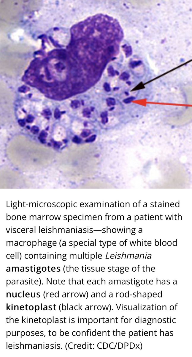M_LaguioVila's tweet photo. Visceral Leishmaniasis
new 🌎 - L infantum (like a new infant)
oLD 🌍 - L donovani
What viscera do these flagellates swim to?
🦴 marrow & liver & spleen
Labs reflect organ dse:
- cytopenias, ⬇️albumin, ⬆️gammaglobulinemia
Dx: BM or spleen bx
Tx: miltefosine, ampho
#IDBoards https://t.co/Pzrq57DObM