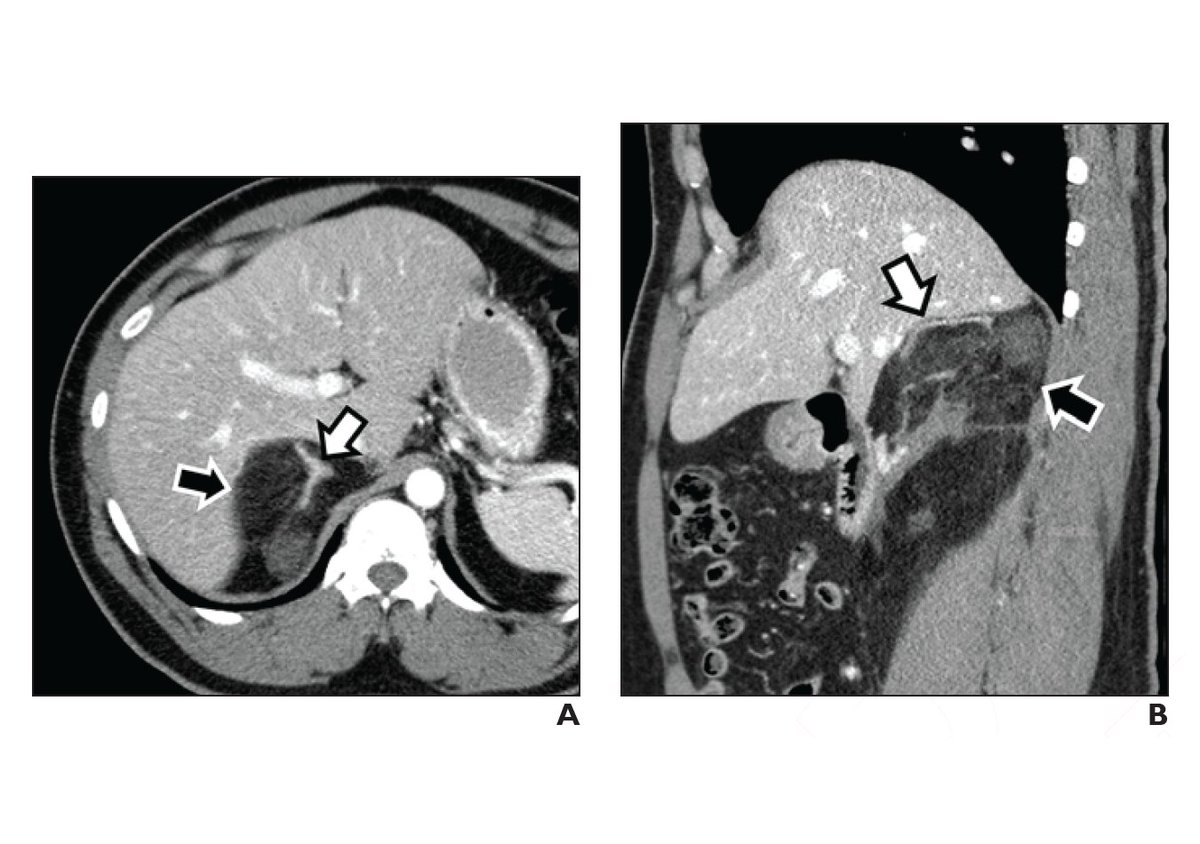 Adrenal mass biopsy has limited diagnostic utility for evaluation of incidental adrenal masses in patients without primary extra-adrenal malignancy.

ajronline.org/doi/10.2214/AJ…