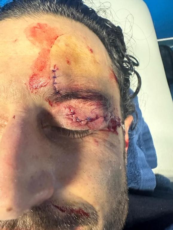 AlexCorboz's tweet photo. Fabio Grosso est vraiment passé à quelques millimètres de perdre son œil hier, les points de suture vont jusqu'à la paupière. La connerie sans nom. #OMOL https://t.co/IOLOPwk0Jk