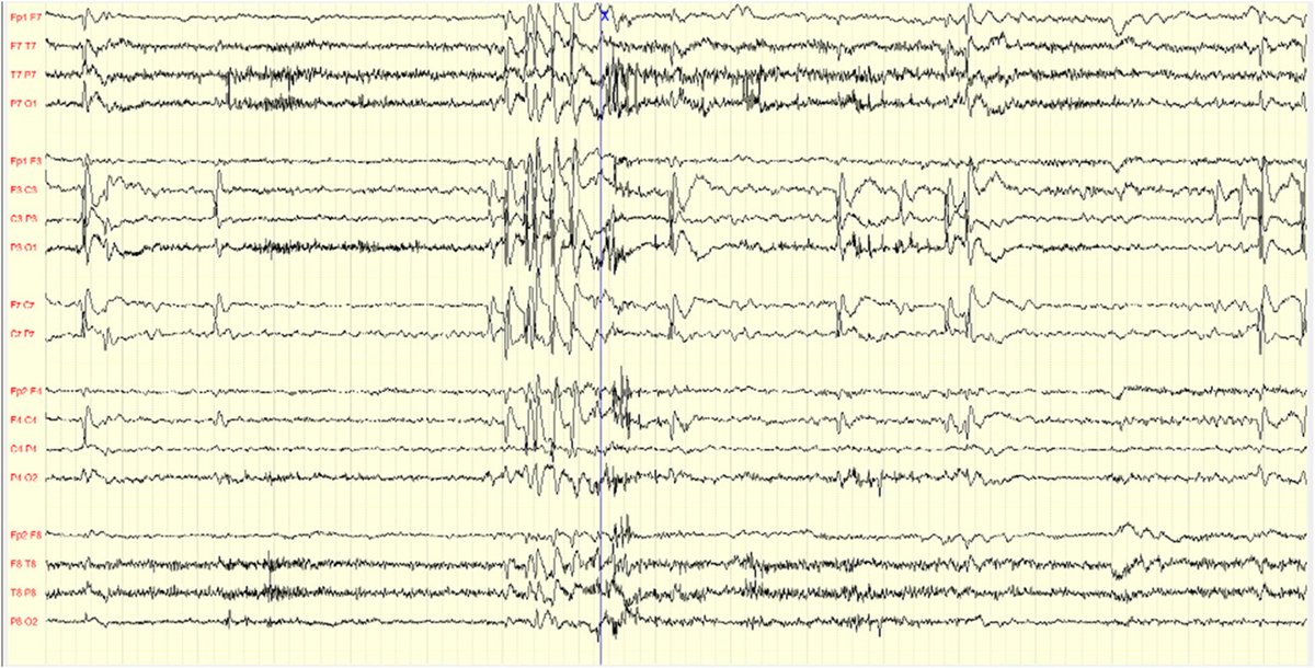 AnnalsCNS's tweet photo. NEW: Although atonic #seizures typically occur with generalized epilepsies, they can present as an atypical manifestation of self-limited focal #epilepsy in childhood. Read more:  https://t.co/ziZHiSjC9n

@WileyNeuro
@vsampat94 https://t.co/xMokPDOT21