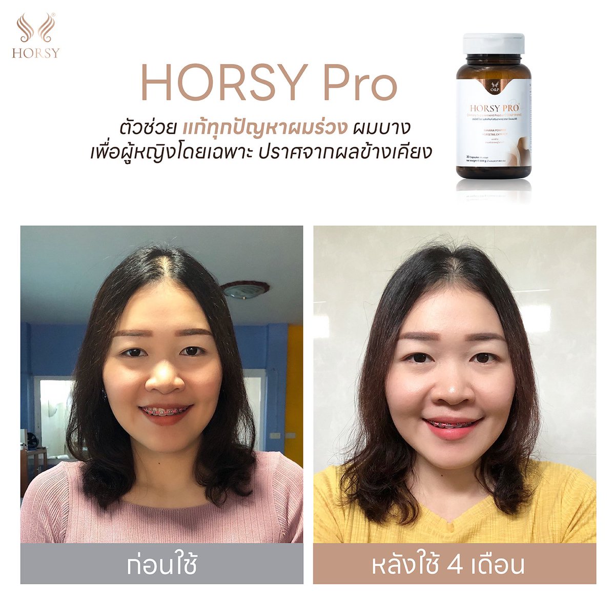 OPHairCareOffi1's tweet photo. อวดรีวิวแบบกรุบกริบ ผลลัพธ์หลังใช้ 4 เดือน #ดูชัดๆที่รอยแสก ดีขึ้นมาก!! อยากดูรีวิวเพิ่ม กดลิงก์นี้ https://t.co/EcgCBJ9y2a https://t.co/ZgxCSnTJD4