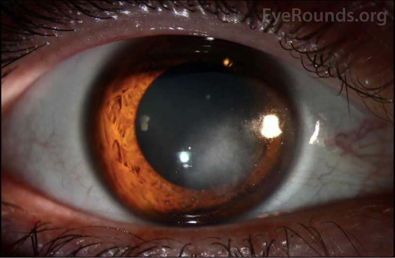 Corneal scarring secondary to interstitial keratitis leads to 2-5% of penetrating keratoplasties, what is on your differential for causes of IK?

eyerounds.org/cases/308-inte…