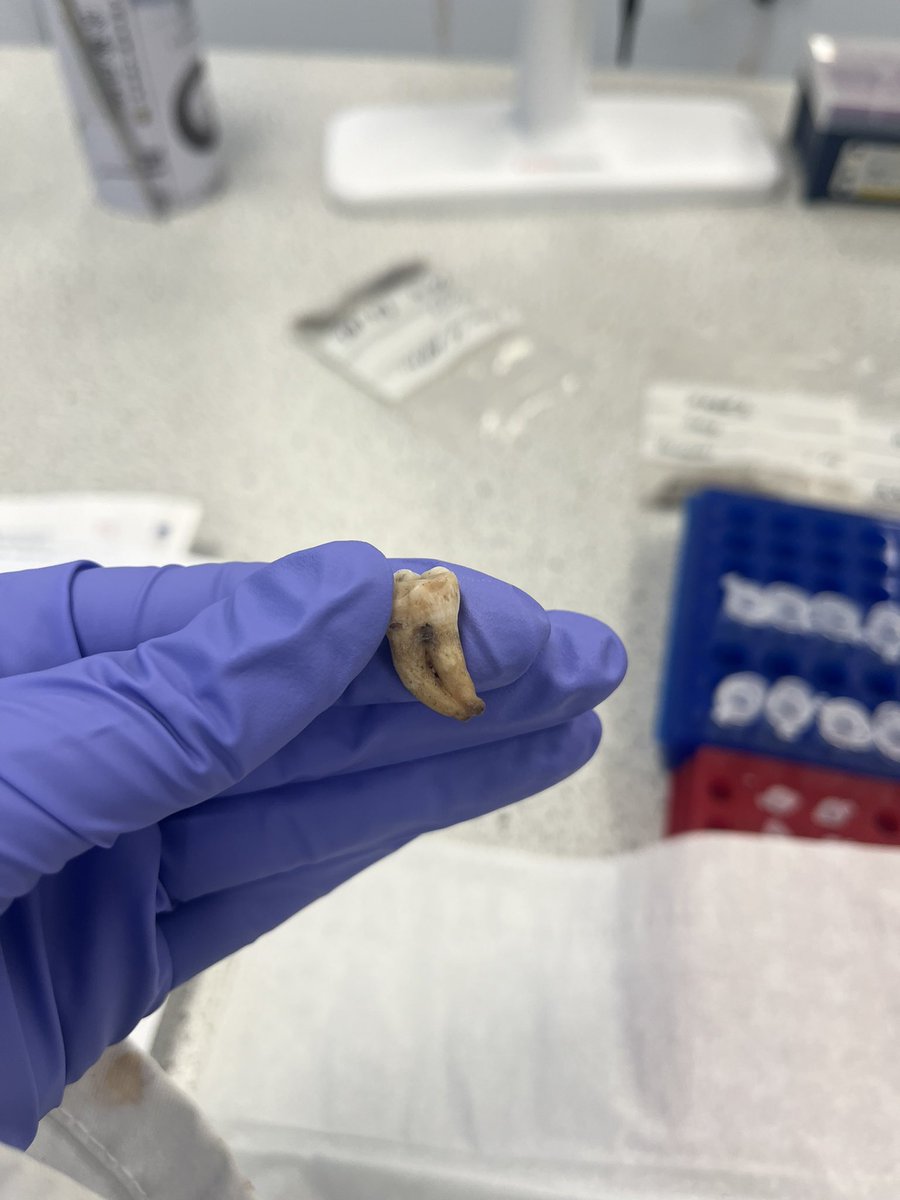 csblacka's tweet photo. Spent this afternoon acid etching some Victorian Human teeth! It felt very fitting foe the day before Halloween.

Also, how painful must that second tooth have been to have! https://t.co/7chI31ACSC