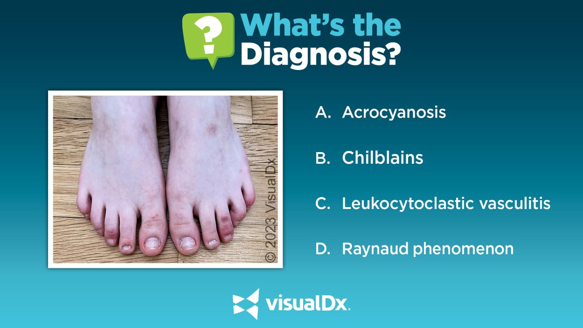 What’s the Dx? 39 yo woman w/ burning & itchy purplish spots on toes for 2 wks. Prior to onset, she walked through snow w/out shoes. No meds or hx of trauma or infection. Exam: dusky, blanching macules & papules were seen on the dorsal feet & toes. Tell us your Dx!