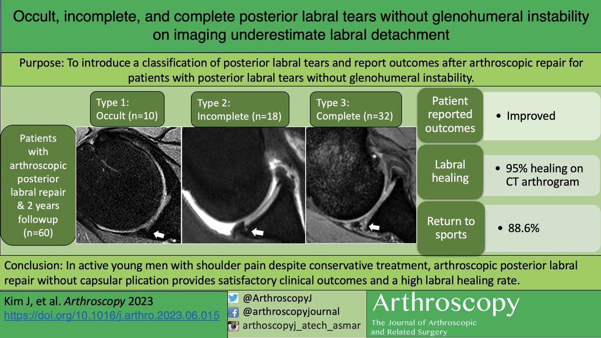 Occult, incomplete, and complete posterior labral tears without glenohumeral instability on imaging underestimate labral detachment #shoulder #arthroscopy #labrum #instability ow.ly/Y5T050Q1UKT