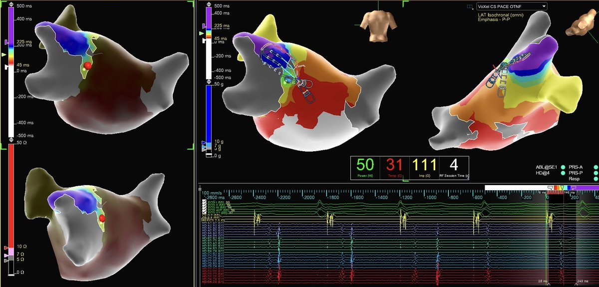 #HDGrid #OTNF quickly identified a discrete leak in prior PVI. One lesion with #TactiCath isolated the vein. #PMA