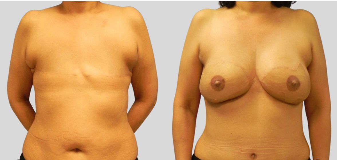 Pioneering progress: An in-depth exploration of #DIEPflap #breastreconstruction techniques | ASPS plasticsurgery.org/news/articles/… #breastcancer #brca <a href="/asps_news/">American Society of Plastic Surgeons (ASPS)</a> <a href="/6state/">Terri Coutee</a> <a href="/diepflapbreast/">PRMA Plastic Surgery</a> <a href="/breastadvocate/">Breast Advocate</a>