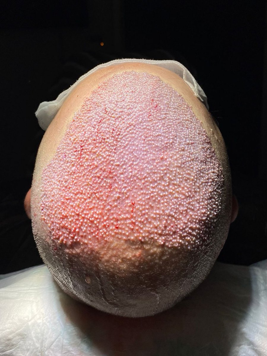 Hairtravel_de's tweet image. 🌱 Frischer Neuanfang! Unser zufriedener Kunde zeigt stolz seinen frisch verpflanzten Oberkopf nach einer erfolgreichen Haartransplantation mit 4200 #Grafts . Bei #HairTravel vermitteln wir Ihnen nicht nur eine Behandlung, sondern auch eine Transformation! 🔄 Lassen Sie die Reise