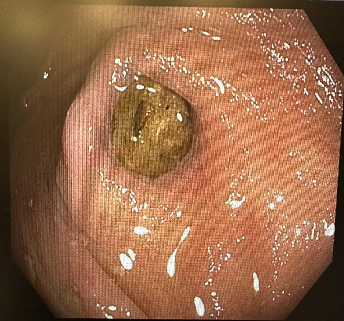 What triggers appendicitis? Despite common belief, definitely NOT stool impaction in the appendix as seen here in this perfectly healthy patient!