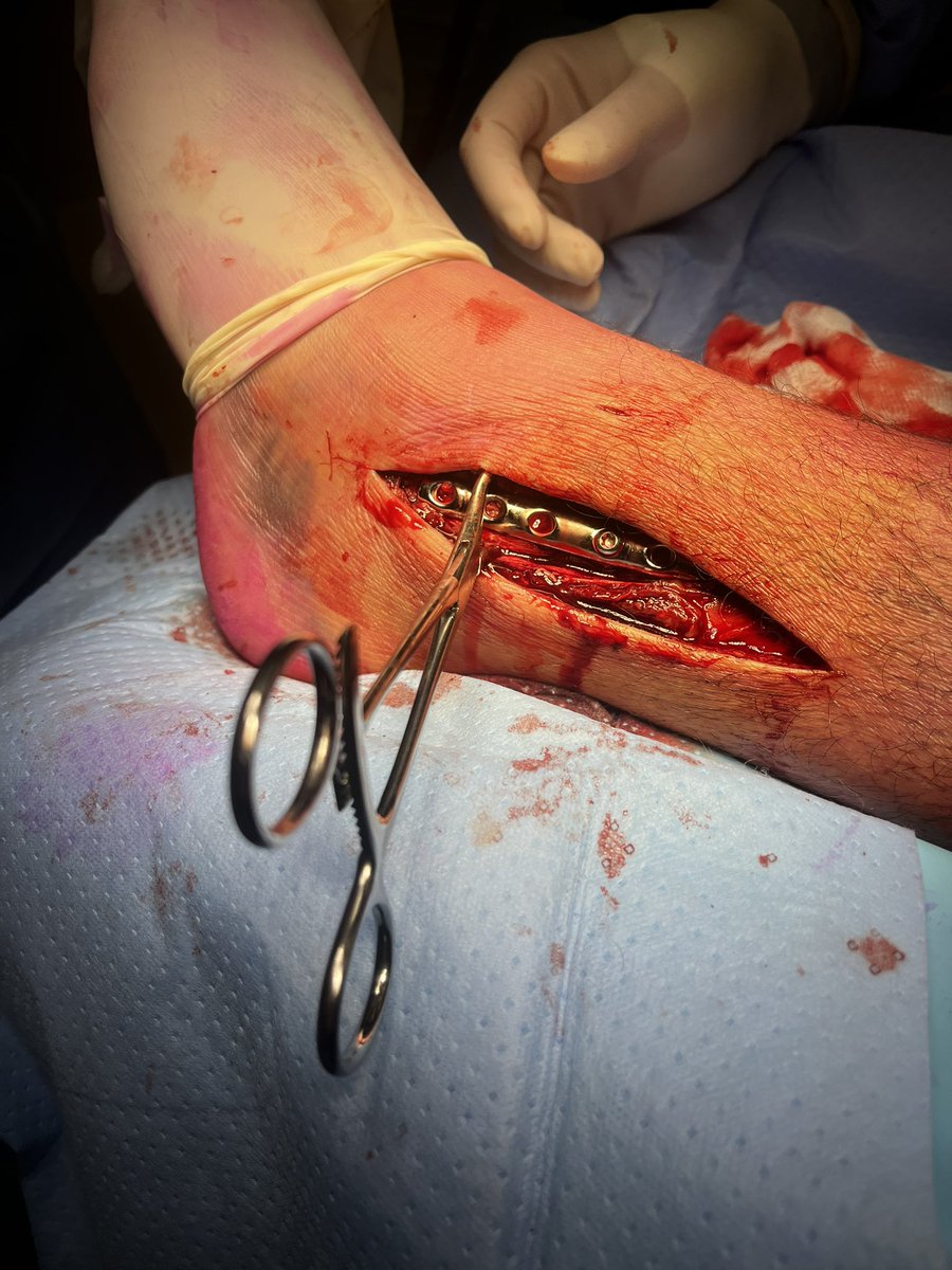 le_Quantum's tweet photo. ⚠️ ATTENTION GRAPHIQUE ⚠️

Voilà, je me suis fait réparer la fracture et j’étais réveillé, du coup on s’est bien marrés avec les chirurgiens.

Got some chrome choomba 🦾🦿

(Tah ma gueule de Toad) https://t.co/WrPMj3ffko