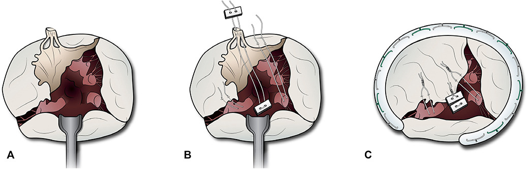 WashU Medicine Division of Cardiothoracic Surgery tweet media
