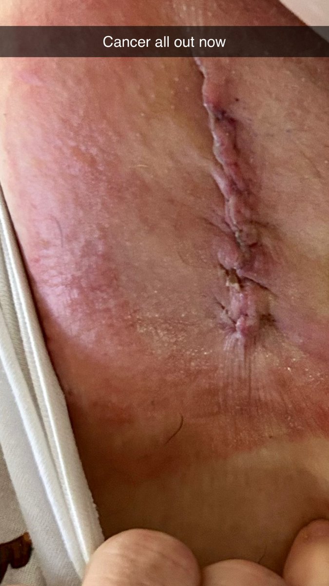 7792_44's tweet image. Skin cancer I will beat you after Opp at James cook last Friday results in 3 weeks